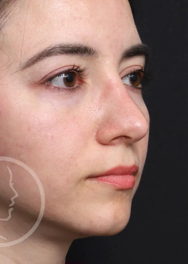 Plastic Surgery Before and After Pictures in Jacksonville, FL - Garcia Facial Plastic Surgery