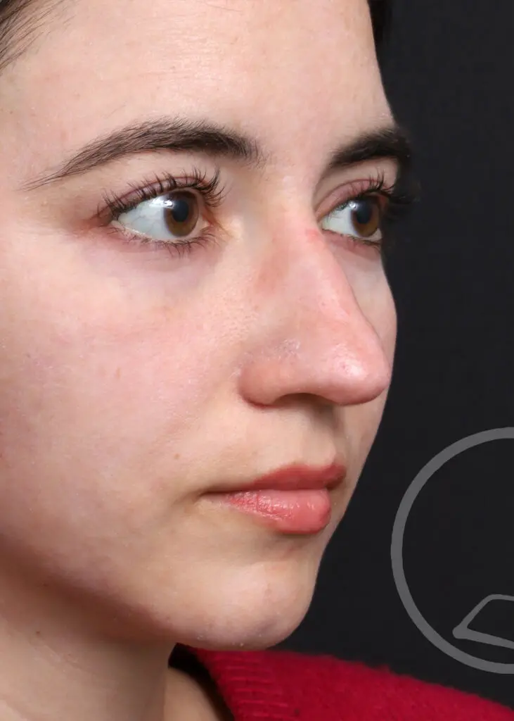 Plastic Surgery Before and After Pictures in Jacksonville, FL - Garcia Facial Plastic Surgery