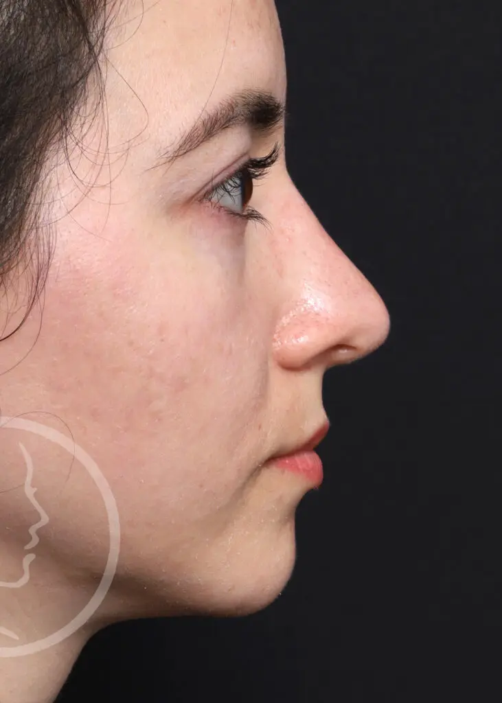 Plastic Surgery Before and After Pictures in Jacksonville, FL - Garcia Facial Plastic Surgery