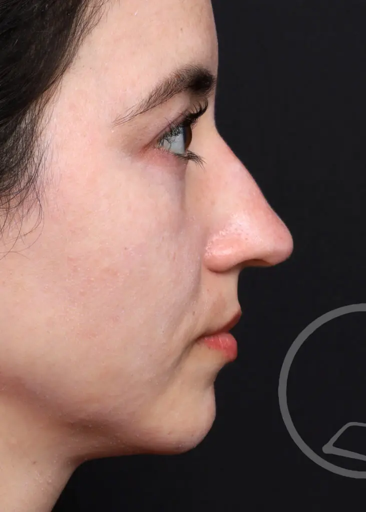 Plastic Surgery Before and After Pictures in Jacksonville, FL - Garcia Facial Plastic Surgery