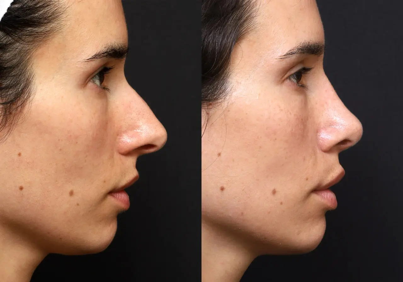 Rhinoplasty Journeys - Garcia Facial Plastic Surgery