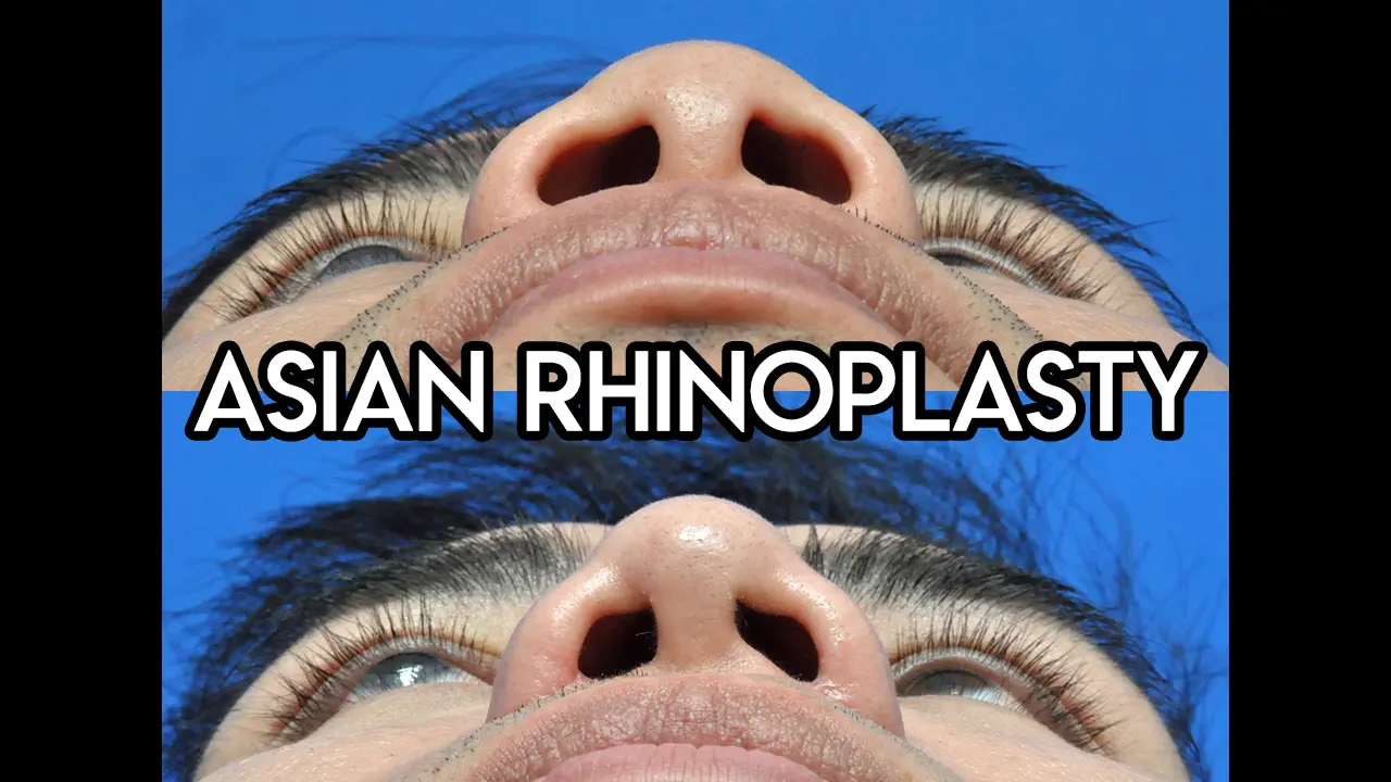 Asian Rhinoplasty