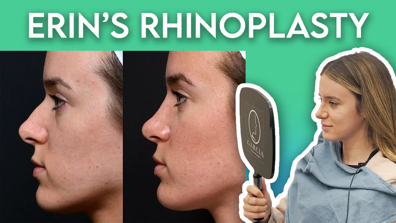 Erin's Rhinoplasty Journey