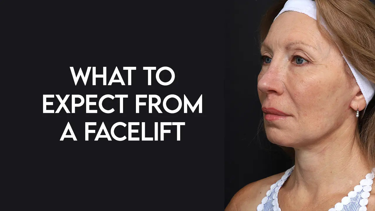What to Expect from a Facelift