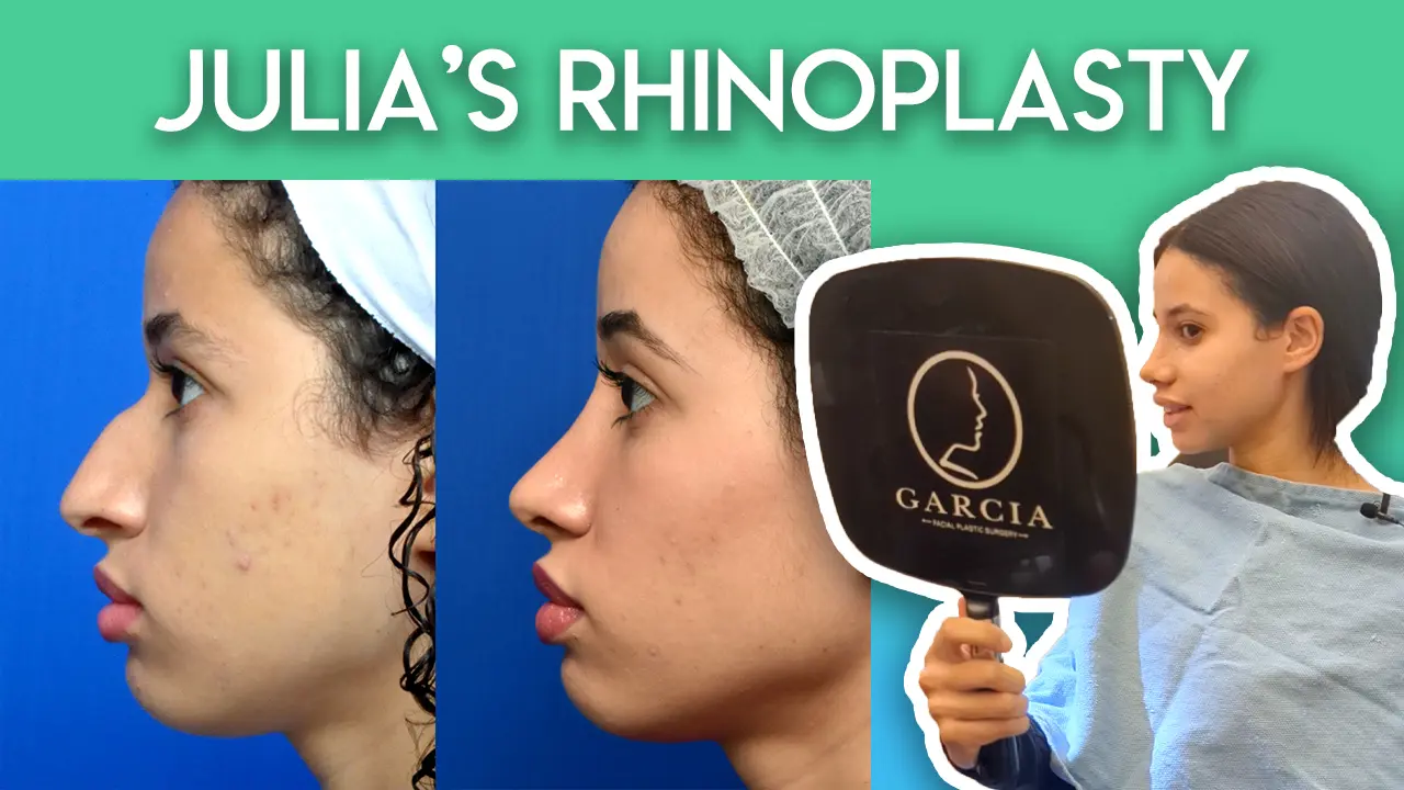Julia's Rhinoplasty Journey
