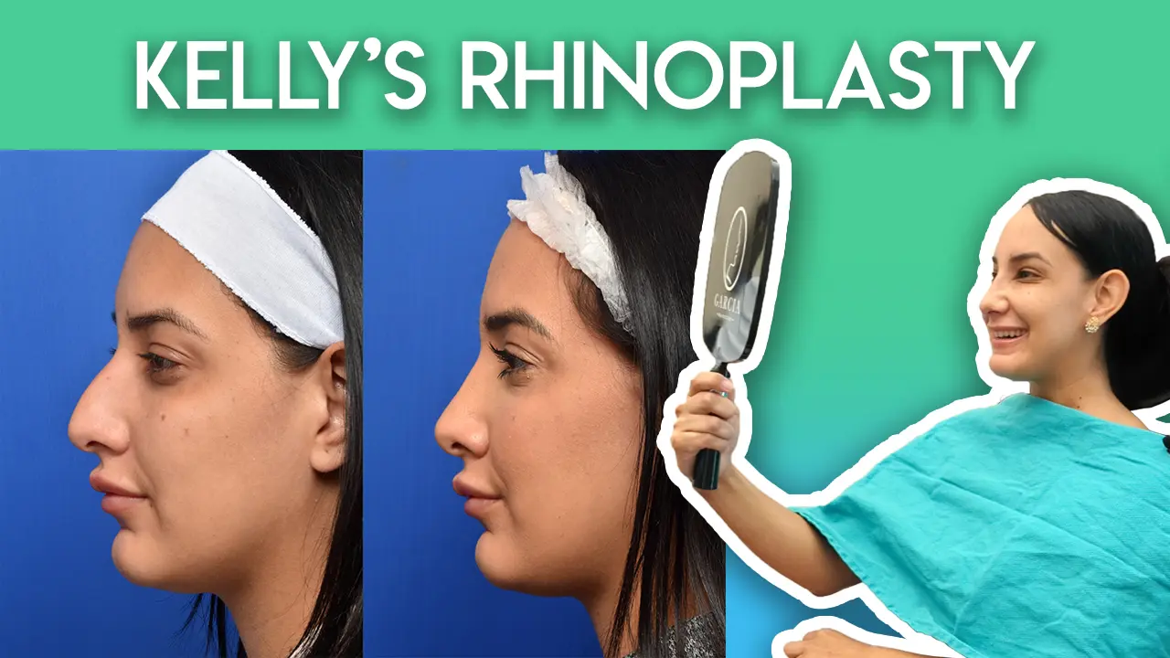 Kelly's Rhinoplasty Journey
