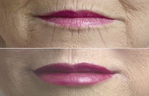 Lip Augmentation Before and After Pictures Jacksonville, FL