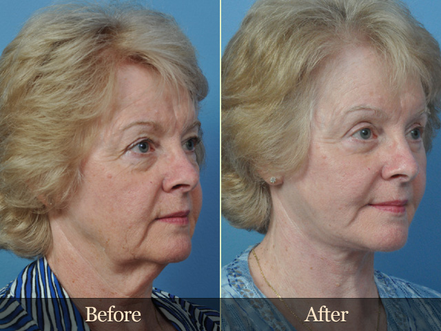 Facelift Before and After Pictures Jacksonville, FL