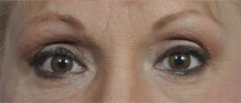 Brow Lift Before and After Pictures Jacksonville, FL