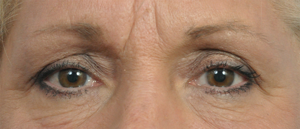 Brow Lift Before and After Pictures Jacksonville, FL