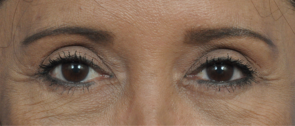 Brow Lift Before and After Pictures Jacksonville, FL