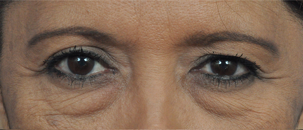 Brow Lift Before and After Pictures Jacksonville, FL