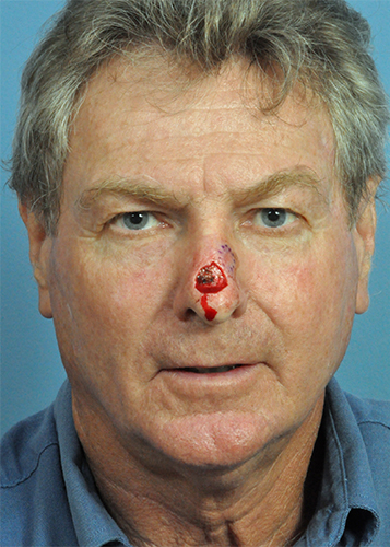 Facial Reconstruction Before and After Pictures Jacksonville, FL