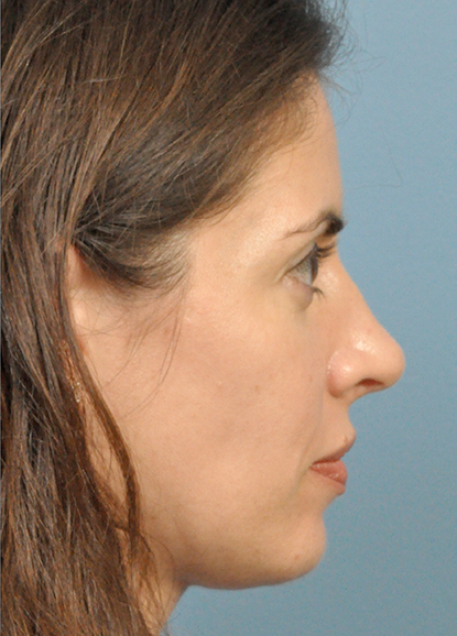 Rhinoplasty Before and After Pictures Jacksonville, FL