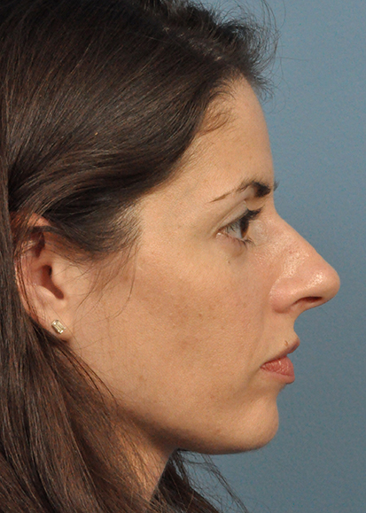 Rhinoplasty Before and After Pictures Jacksonville, FL