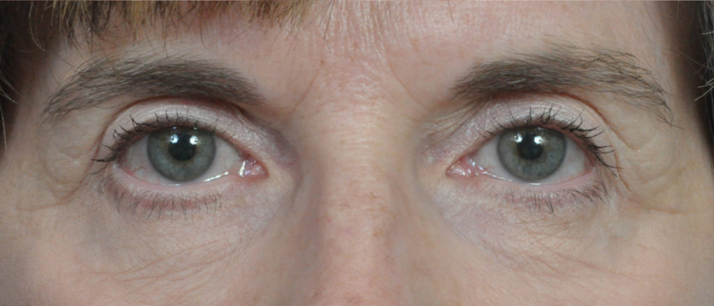 Blepharoplasty Before and After Pictures Jacksonville, FL