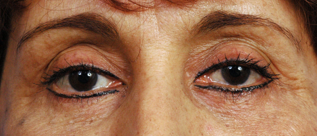 Blepharoplasty Before and After Pictures Jacksonville, FL