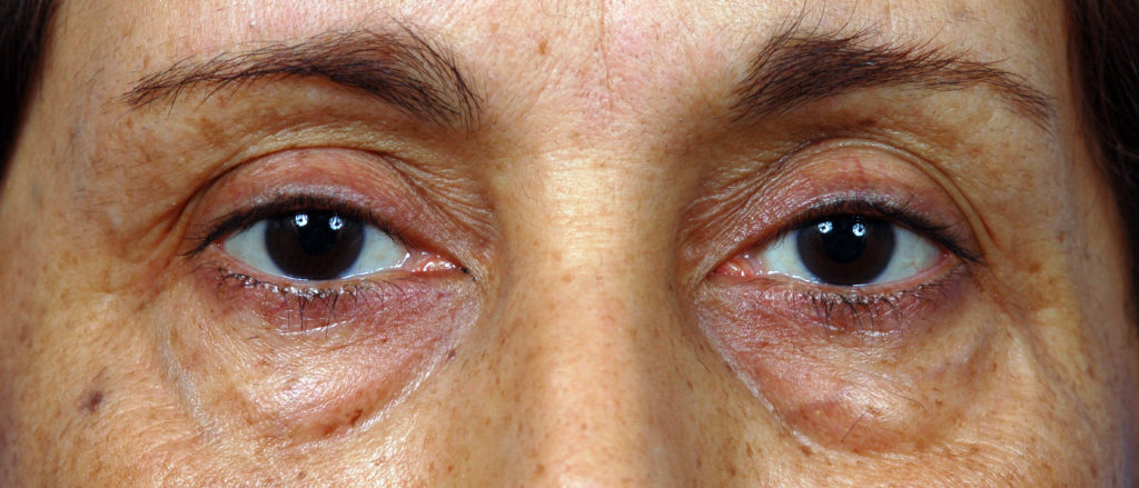 Blepharoplasty Before and After Pictures Jacksonville, FL