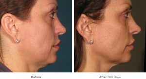 Ultherapy Before and After Pictures Jacksonville, FL