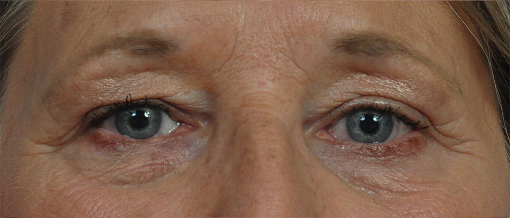 Brow Lift Before and After Pictures Jacksonville, FL