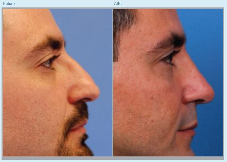 Rhinoplasty Before and After Pictures Jacksonville, FL