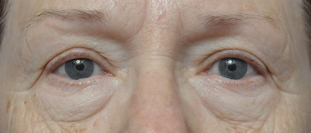 Brow Lift Before and After Pictures Jacksonville, FL