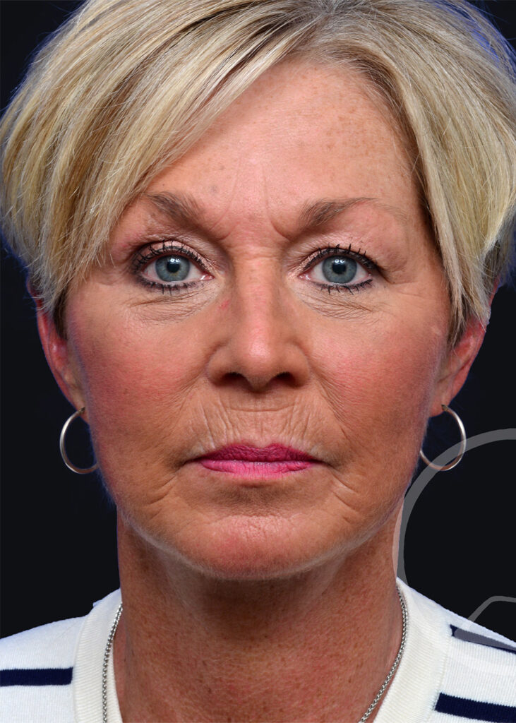 Plastic Surgery Before and After Pictures in Jacksonville, FL - Garcia Facial Plastic Surgery