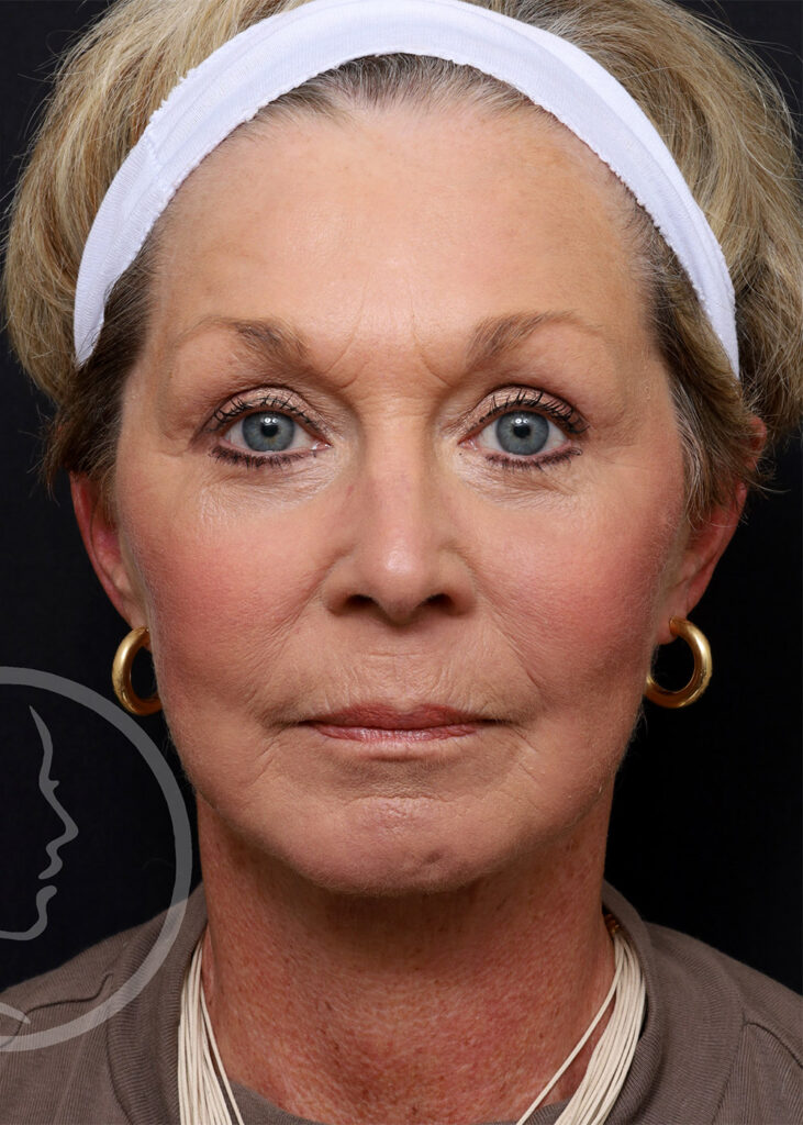 Plastic Surgery Before and After Pictures in Jacksonville, FL - Garcia Facial Plastic Surgery