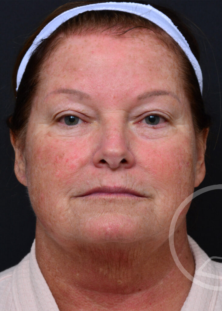 Plastic Surgery Before and After Pictures in Jacksonville, FL - Garcia Facial Plastic Surgery