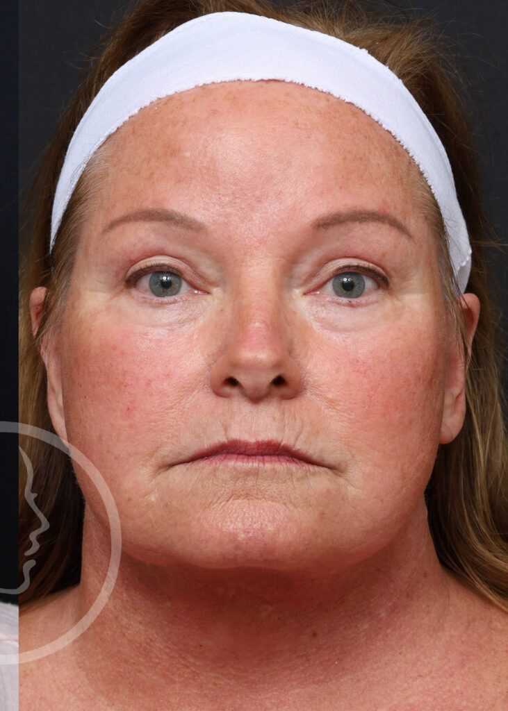 Plastic Surgery Before and After Pictures in Jacksonville, FL - Garcia Facial Plastic Surgery