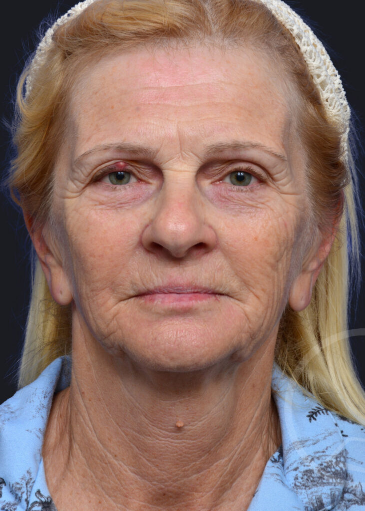 Plastic Surgery Before and After Pictures in Jacksonville, FL - Garcia Facial Plastic Surgery