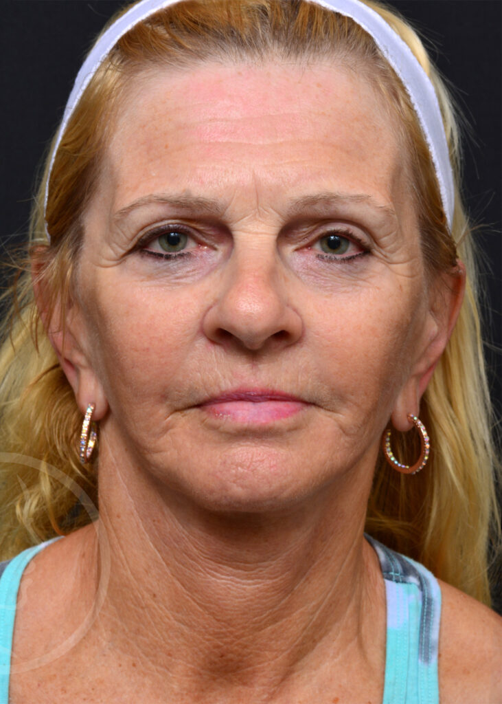 Plastic Surgery Before and After Pictures in Jacksonville, FL - Garcia Facial Plastic Surgery