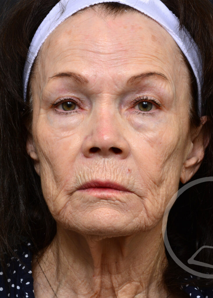 Plastic Surgery Before and After Pictures in Jacksonville, FL - Garcia Facial Plastic Surgery
