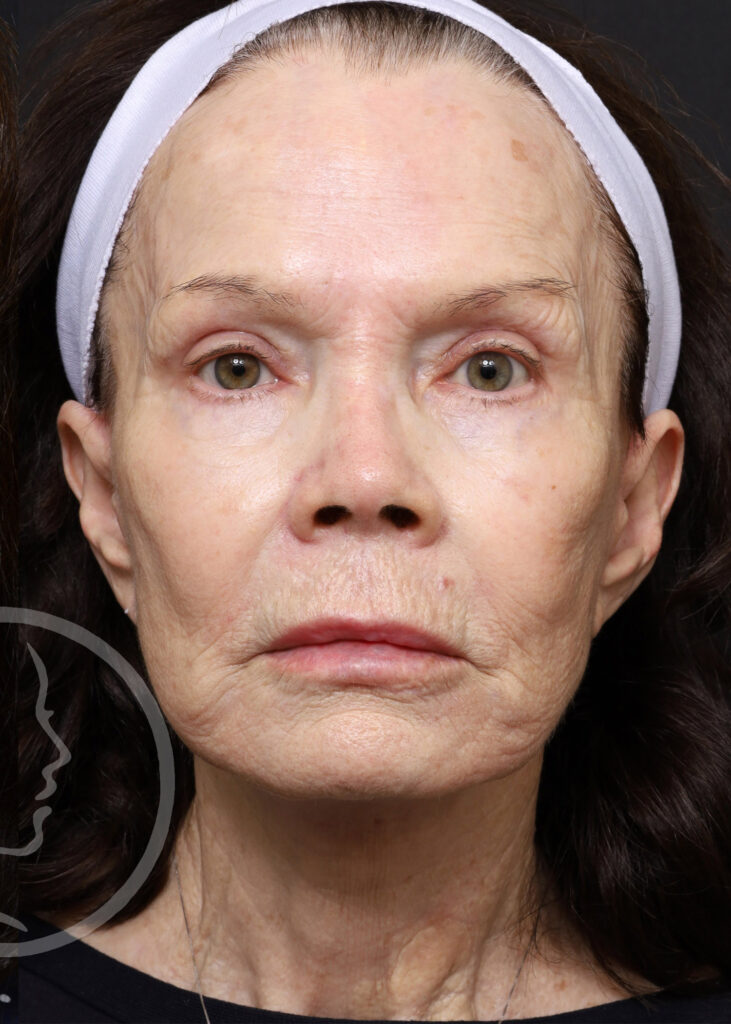 Plastic Surgery Before and After Pictures in Jacksonville, FL - Garcia Facial Plastic Surgery
