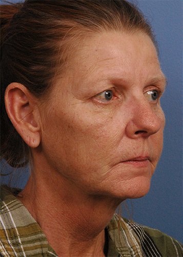 Chemical Peel Before and After Pictures Jacksonville, FL