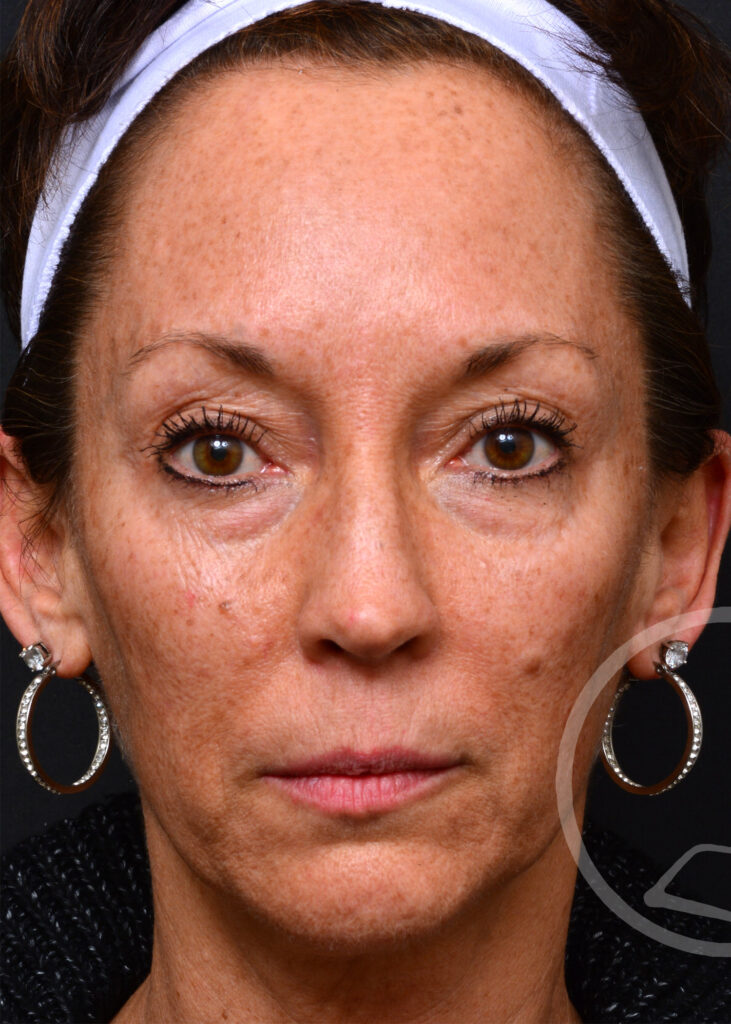Plastic Surgery Before and After Pictures in Jacksonville, FL - Garcia Facial Plastic Surgery