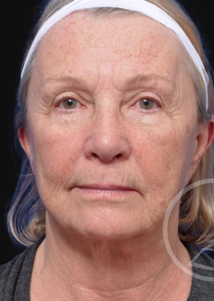 Plastic Surgery Before and After Pictures in Jacksonville, FL - Garcia Facial Plastic Surgery