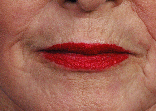 Dermabrasion Before and After Pictures Jacksonville, FL