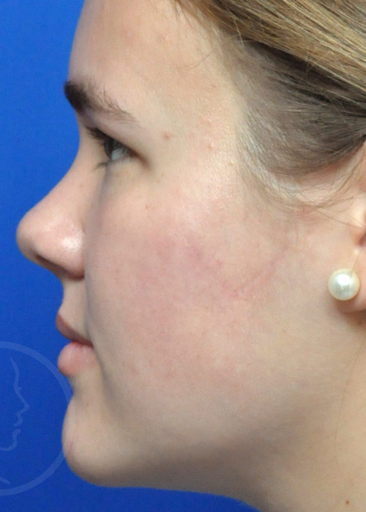 Scar Revision Before And After Pictures In Jacksonville, FL
