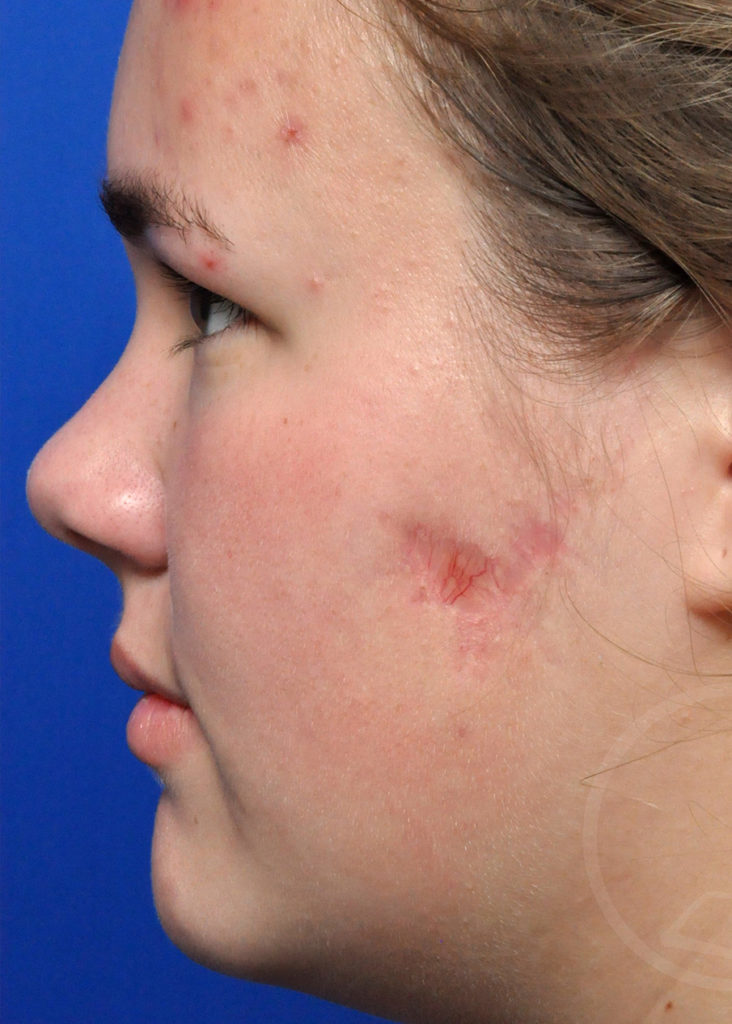 Scar Revision Before And After Pictures In Jacksonville, FL