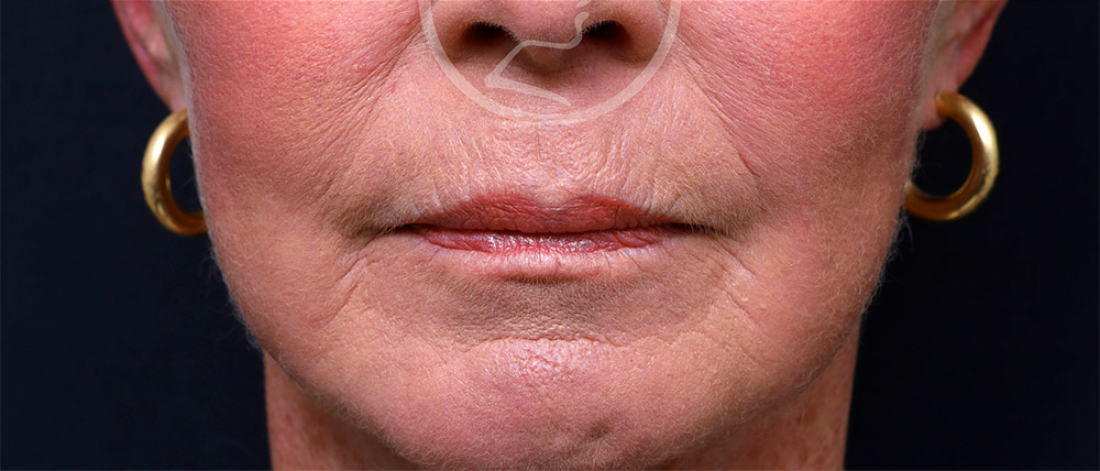 Plastic Surgery Before and After Pictures in Jacksonville, FL - Garcia Facial Plastic Surgery