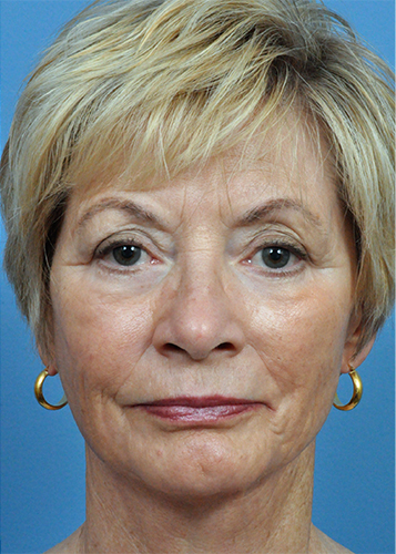 Dermabrasion Before and After Pictures Jacksonville, FL