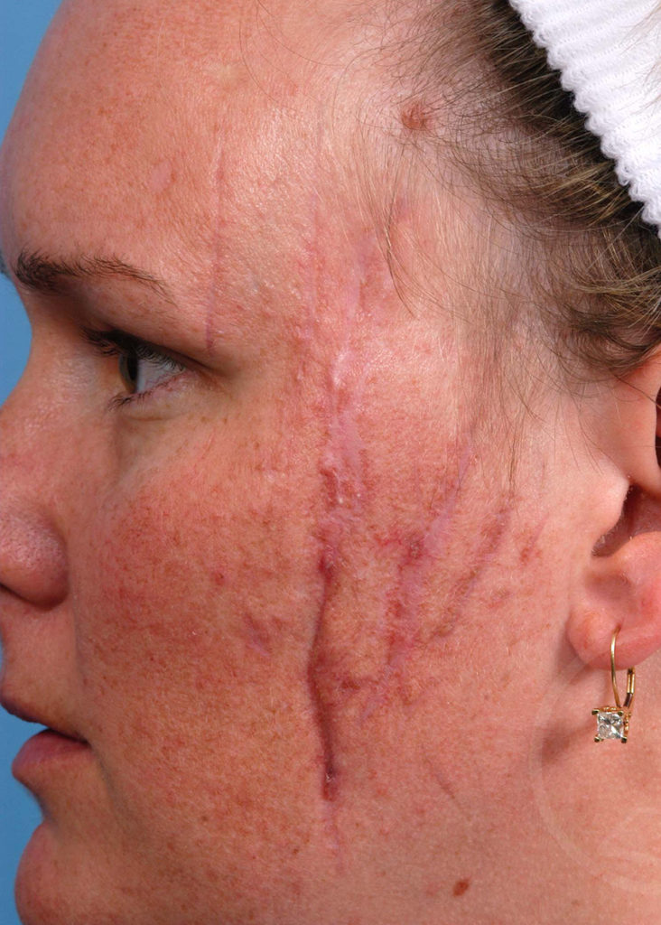 Scar Revision Before And After Pictures In Jacksonville, FL