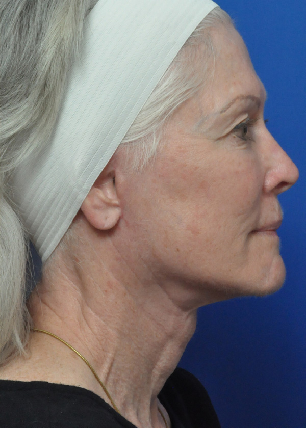 Neck Lift Before and After Pictures Jacksonville, FL