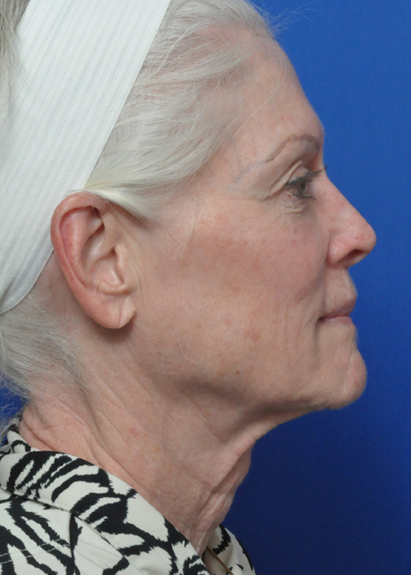 Neck Lift Before and After Pictures Jacksonville, FL