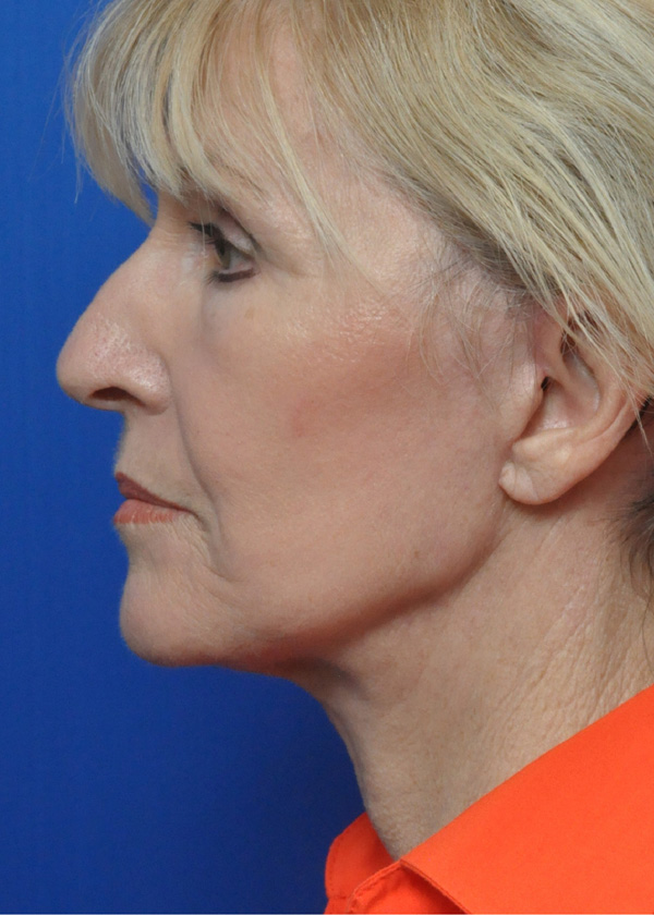 Neck Lift Before and After Pictures Jacksonville, FL