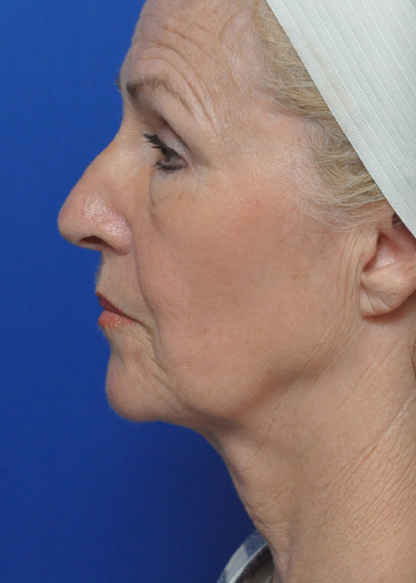 Neck Lift Before and After Pictures Jacksonville, FL