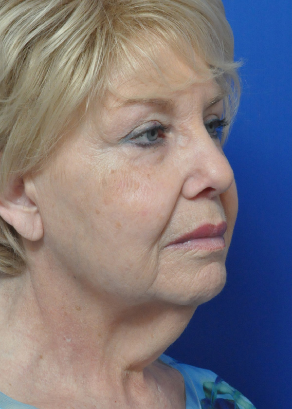 Neck Lift Before and After Pictures Jacksonville, FL