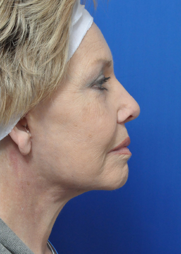Neck Lift Before and After Pictures Jacksonville, FL