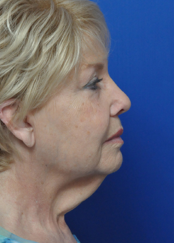 Neck Lift Before and After Pictures Jacksonville, FL